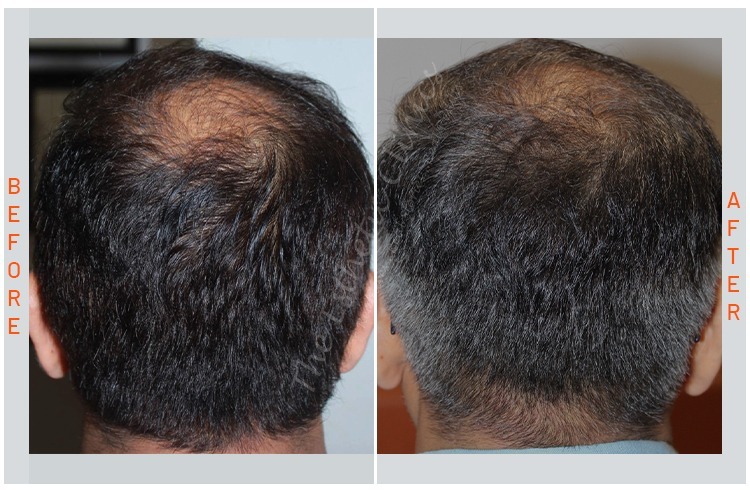 GFC Hair Treatment, gfc before after photos in mumbai india 